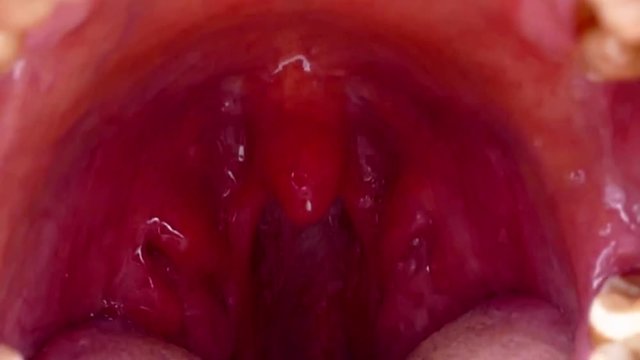 Intraoral tonsil in the mouth, tonsillitis, neglected human mouth,