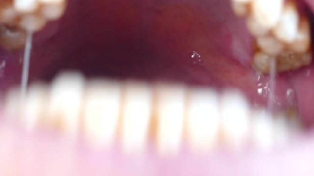 Intraoral tonsil in the mouth, tonsillitis, neglected human mouth,