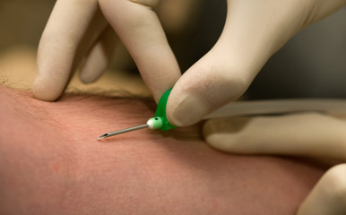 Injection into a vein with a butterfly syringe