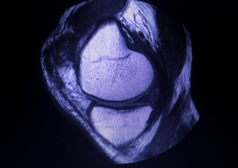 MRI knee meniscus tear scan - obrazy, fototapety, plakaty