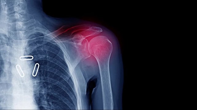 footage of x-ray shoulder pain or frozen shoulder