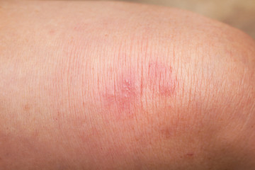 Woman have red rash allergy on knee leg top view background