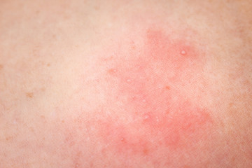 Woman have red rash allergy on her leg closeup skin background