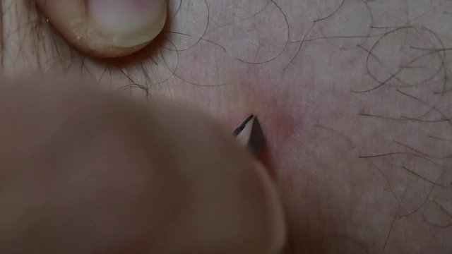 Removing tick tweezers, danger, borreliosis, disease, bug. Dog Tick, Dermacentor variabilis, Encephalitis, Ixodes scapularis in the human skin eating blood