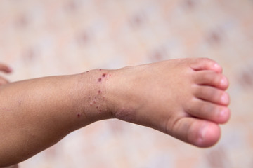 Boy with symptoms hand, foot and mouth disease . children "  HFMD " with disease .Mouth Foot and Mouth Disease caused by a strain of Coxsackie virus. right rash with maculopapular lesions on skin .