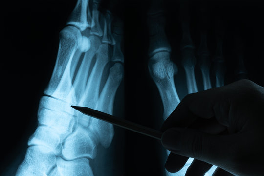 X ray film with doctor's hand to examine