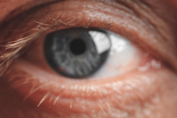 the eye is severely inflamed. macro reddening. have toning. focus on the eyelash