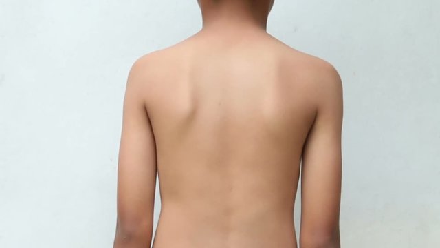 Asian kid with scoliosis