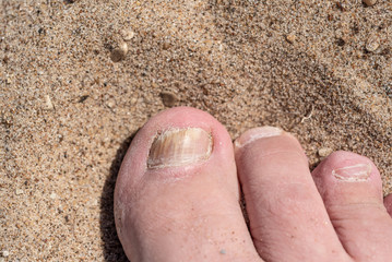 Toes with fungus - the concept of skin diseases in the summer on the beach