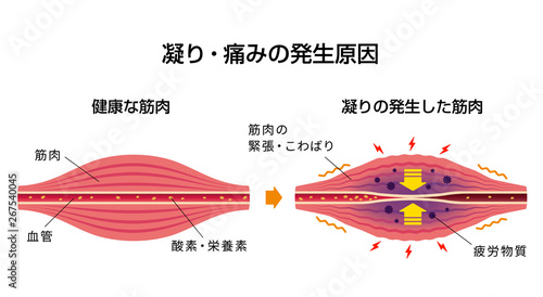 肩こり 凝り 痛みの発生原因イラスト Wall Mural Barks 肩こり 凝り 痛みの発生原因イラスト Wall Mural Barks