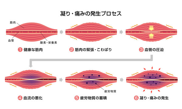 血管の圧迫 Images Browse 14 Stock Photos Vectors And Video Adobe Stock