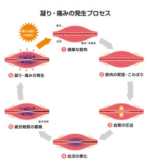 肩こり（凝り）・痛みの発生プロセス (6ステップ/サークル) イラスト