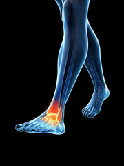 Obraz premium 3d rendered medically accurate illustration of a painful ankle