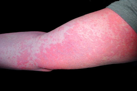 Allergische Reaktion auf Antibiotikum