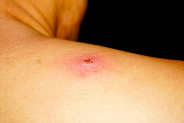 Acne skin problem on back side man surface