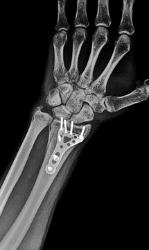 orthopedic fixation plate radial fracture