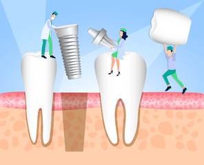 Dentists install a dental implant. Dentistry. Implantation and treatment of human teeth. Vector illustration