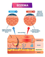 Eczema vector illustration. Labeled anatomical structure comparative scheme