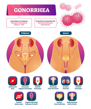 Gonorrhea vector illustration. Labeled STD disease explanation symptom list