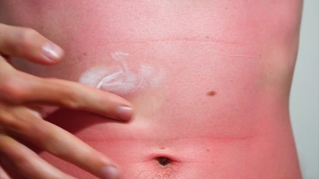 the young man rubs his sunburned belly with ointment macro isolated