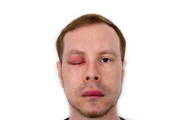 ein Mann mit geschwollenem Auge und dicker Lippe von einem Bienenstich