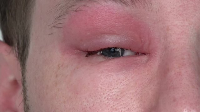 ein Mann mit geschwollenem Auge von einem Bienenstich