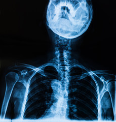 Cervical X-ray film