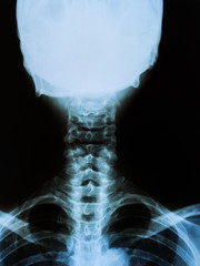 Cervical X-ray film