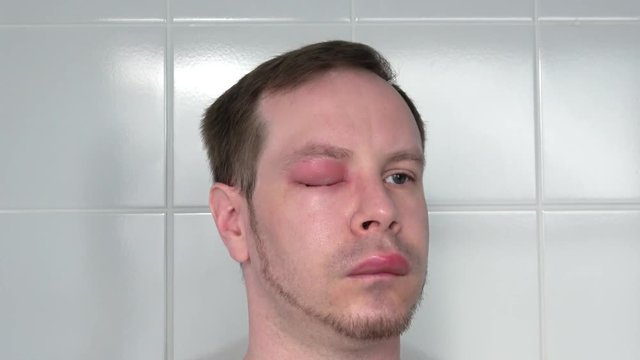 ein Mann mit geschwollenem Auge und dicker Lippe von einem Bienenstich