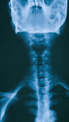 Cervical X-ray film close-up