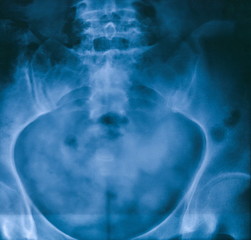 Pelvis X-ray film