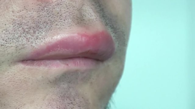 ein Mann mit geschwollener Lippe von einem Bienenstich