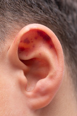 small bruises on the ear