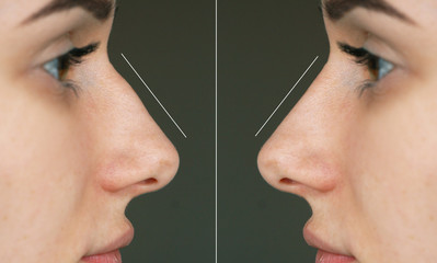 Obraz premium rhinoplasty of the nose with a crook