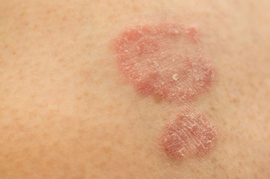 Psoriasis skin. Two psoriatic plaques on light skin. Psoriasis is an incurable autoimmune human disease.Soft focus.