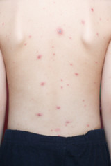 Chicken pox rash on young boy body.Chickenpox is an infection caused by the varicella zoster virus. It begins as a blister-like rash that originates on the face and trunk