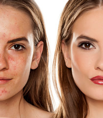 Comparison portrait of young beautiful woman before and after skin treatment and makeup on white...