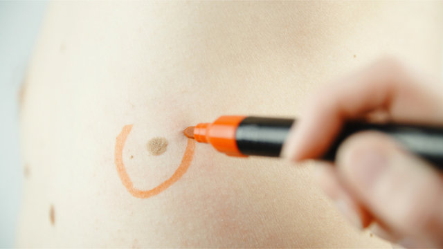 Marking A Melanoma Skin Mole