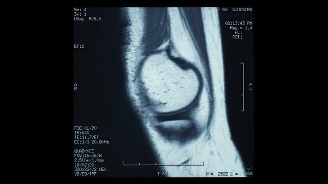 Time Lapse video animation of R.M.N. Nuclear magnetic resonance, of human knees, with cross-section and sagittal section.