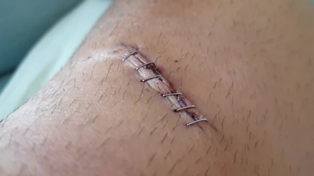 Removing the metal staples (saturates) on one knee with the grapple remover