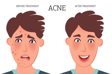 Obraz premium The concept of acne on the skin before and after treatment