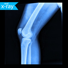 The x-ray of a person's legs. Roentgen of the knee joint. A picture of a skeleton. A real X-ray, medical background. Medicine.