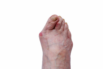 Curvature of the big toe