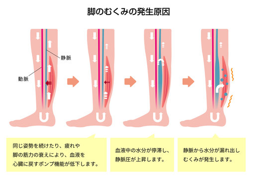 脚のむくみ（浮腫）の発生原因・過程　イラスト