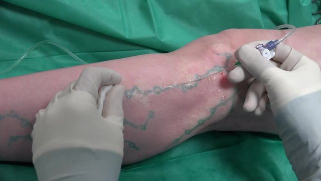 Varicose veins are superficial veins that have become enlarged and twisted. Typically they occur just under the skin in the legs. 