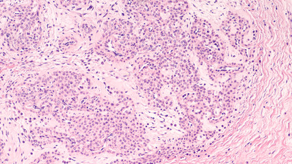 Microscopic image of a glomus tumor, a painful benign tumor of the glomus body, typically under the nail of fingers or toes.   