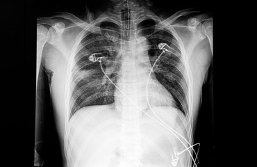 Chest X ray film of a patient with dyspnea