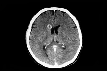 CT scan of a patient with brain abscess