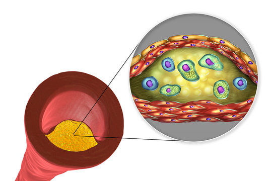 Structure of atherosclerotic plaque. Illustration showing necrotic center, foam cells, T-lymphocytes inside of cholesterol plaque with walls made of smooth muscle cells and endothelium of blood vessel