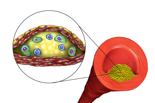 Structure of atherosclerotic plaque. Illustration showing necrotic center, foam cells, T-lymphocytes inside of cholesterol plaque with walls made of smooth muscle cells and endothelium of blood vessel